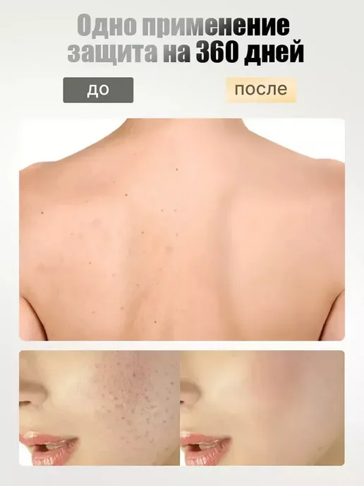 Мыло от подростковых прыщей, вариант, фото 4