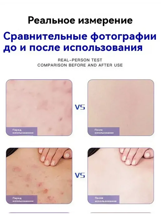 Мыло от подростковых прыщей, вариант, фото 3
