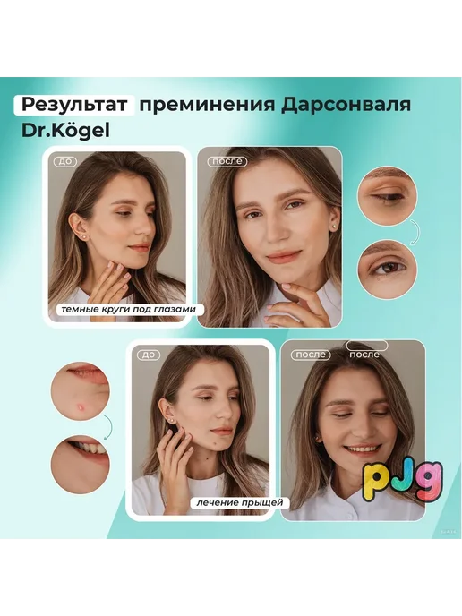 Дарсонваль для лица с регулировкой мощности, белый, фото 4
